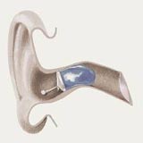 История развития слуховых аппаратов. Какими были слуховые аппараты. Где купить слуховой аппарат. Лучшие производители слуховых аппаратов.